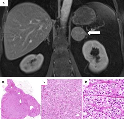 Case Report: Consecutive Adrenal Cushing’s Syndrome and Cushing’s Disease in a Patient With Somatic CTNNB1, USP8, and NR3C1 Mutations